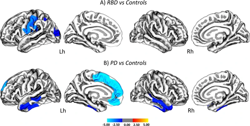 Diagnosis Of Rem Sleep Behavior Disorder