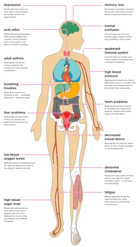 What Is Sleep Apnea?